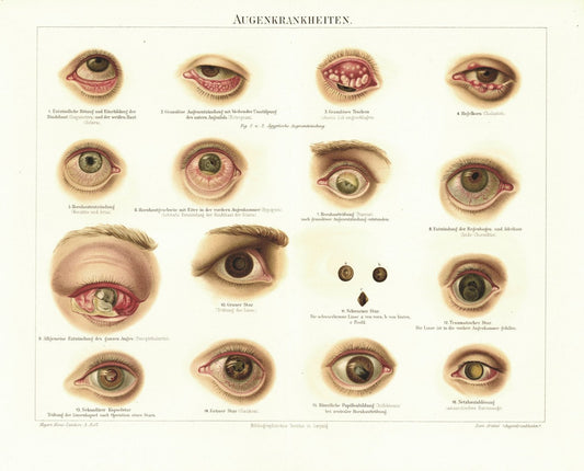 Augenkrankheiten. Lithografie von 1893